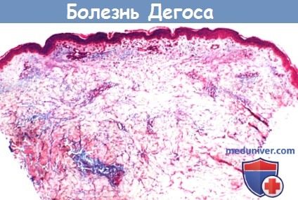 Злокачественный атрофический папулез (болезнь Дегоса)