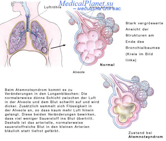 тяжесть приступа бронхиальной астмы