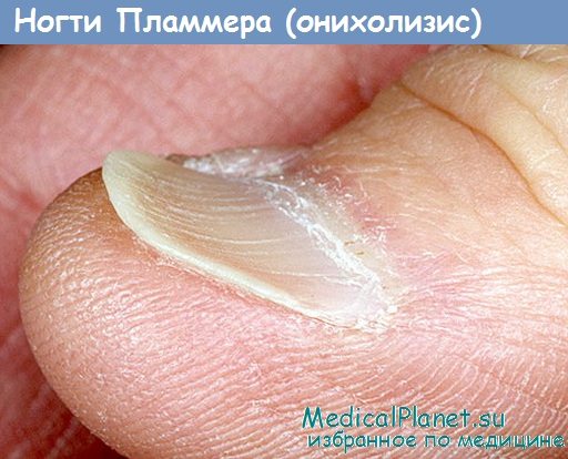 Ногти Пламмера - онихолизис