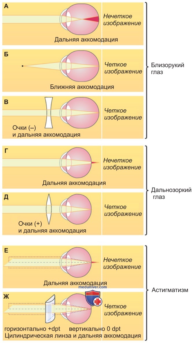 Глаз и диоптрический аппарат