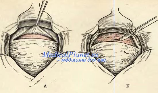 Перешеечное кесарево сечение с поперечным разрезом
