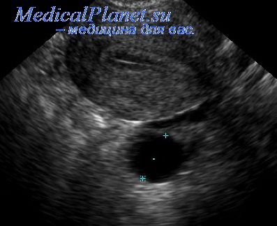 Эндометрий при переносе эмбриона. Темное пятно на УЗИ матки. Чёрное пятнышко на УЗИ матки. Черная точка в матке на УЗИ.