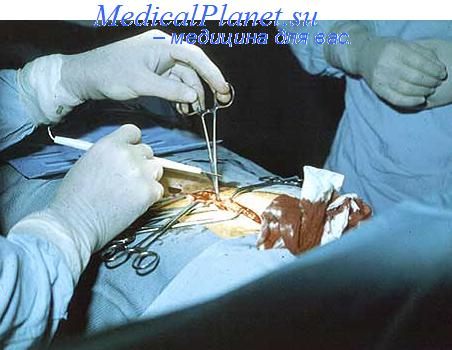 операции в гинекологии