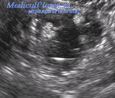 внутриматочная перегородка при беременности