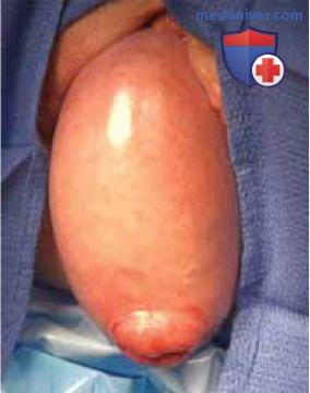 Облитерирующая операция частичный влагалищный клейзис (операция Лефора) при выпадении тазовых органов