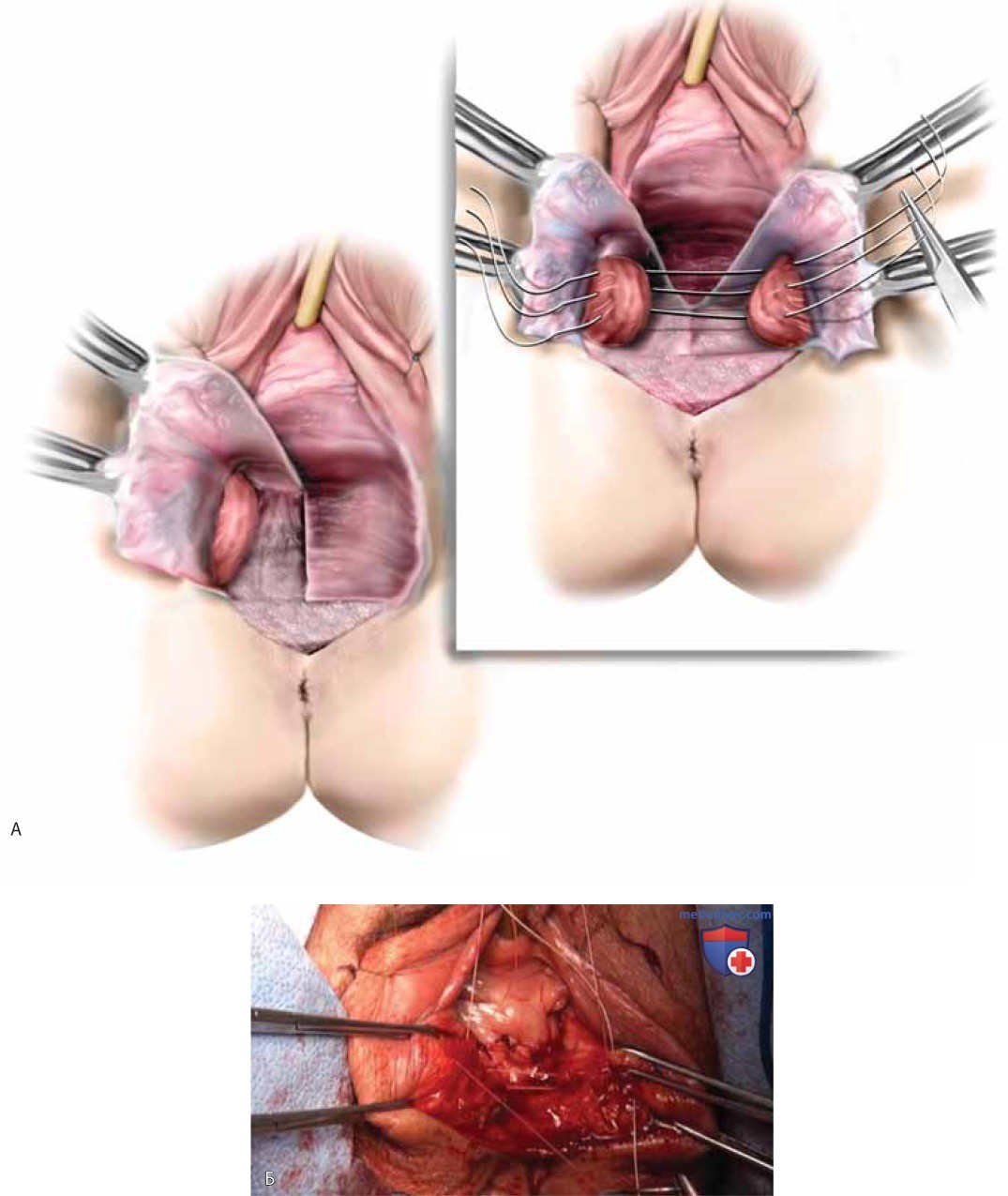 Облитерирующая операция частичный влагалищный клейзис (операция Лефора) при выпадении тазовых органов