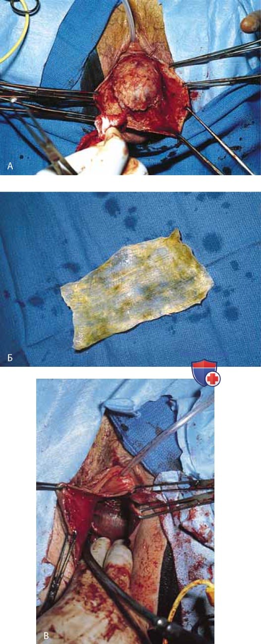 Пластика выпадения влагалища биологическими трансплантатами и синтетическими сетками