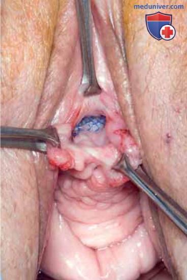 Осложнения петлевых операций укрепления среднего отдела уретры