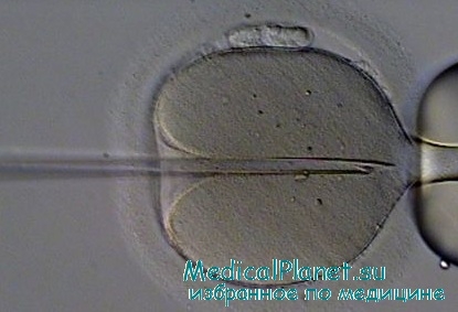 инъекция сперматозоидов