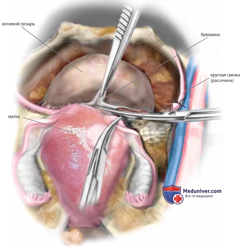 Тотальная абдоминальная гистерэктомия с двусторонней сальпингоофорэктомией: техника, инструменты