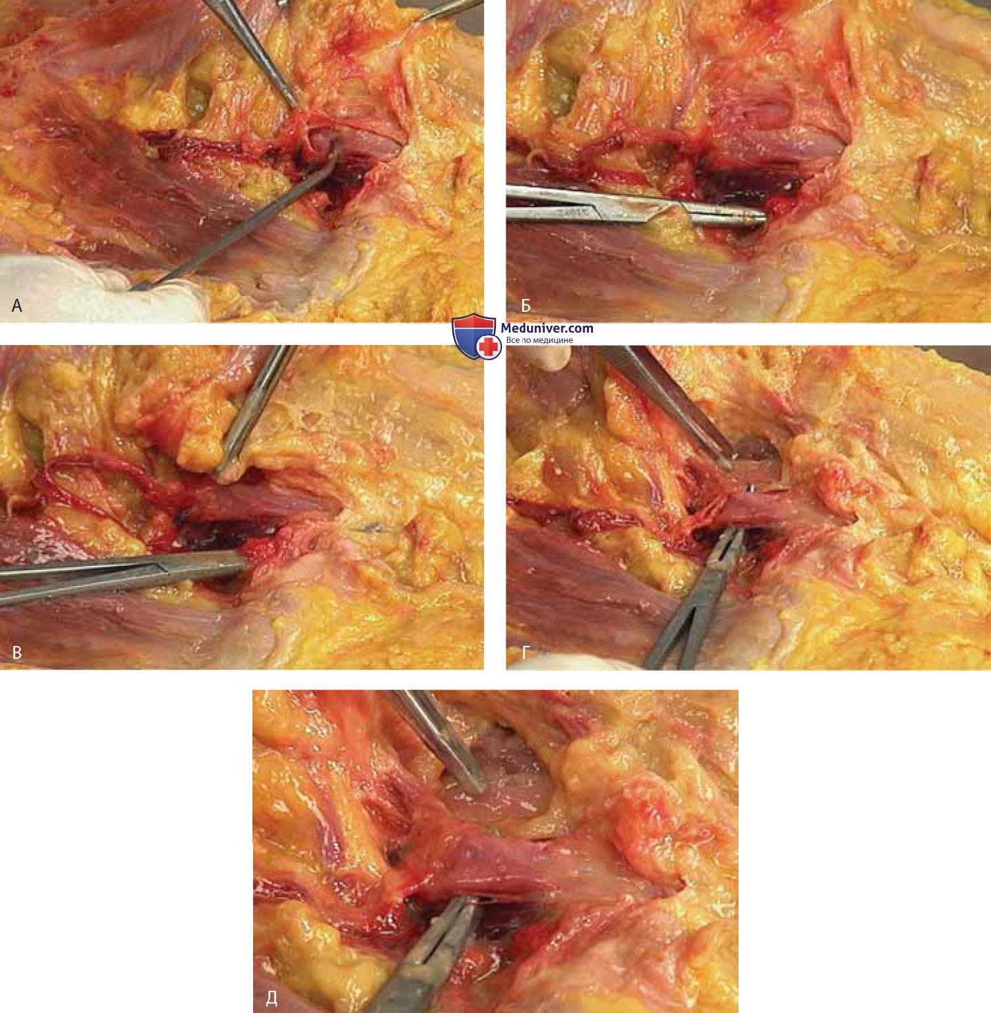 Анатомия нижнего отдела передней брюшной стенки