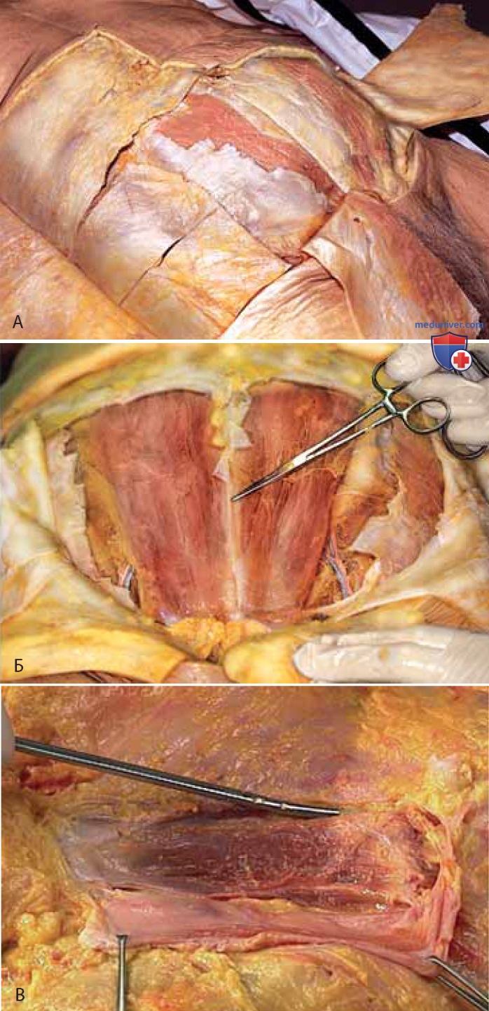 Анатомия нижнего отдела передней брюшной стенки