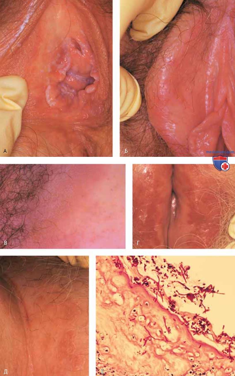 Инфекционные болезни вульвы и женской промежности: атлас фотографий