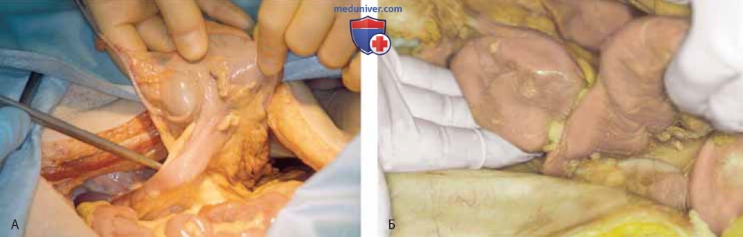 Хирургическая анатомия тонкого и толстого кишечника