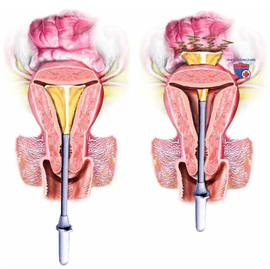 Малоинвазивная негистероскопическая абляция эндометрия: техника операции, этапы