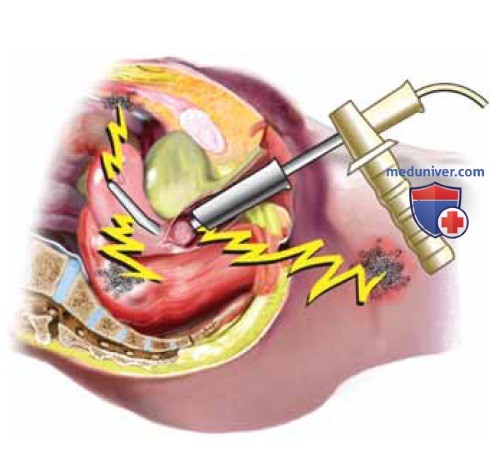 Малоинвазивная негистероскопическая абляция эндометрия: техника операции, этапы