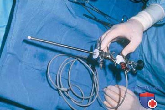 Гистероскопическая абляция эндометрия: техника операции, этапы