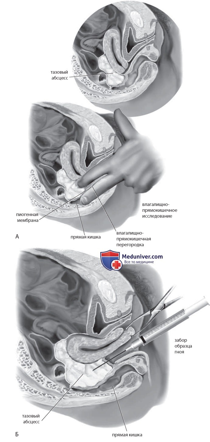 Операция при пиосальпинксе, тубоовариальном абсцессе и тазовом абсцессе