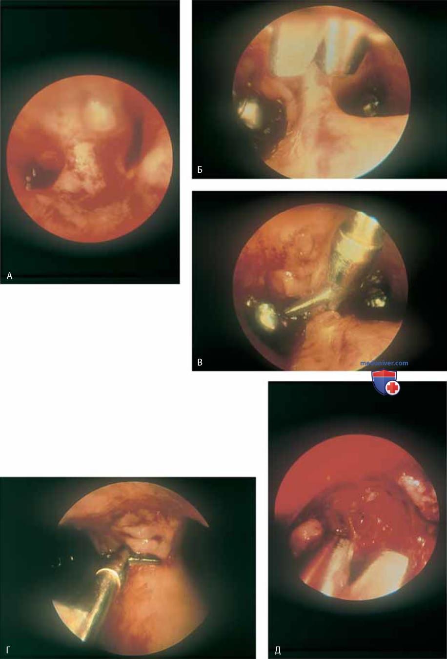 Гистероскопическое рассечение внутриматочной перегородки: техника операции, этапы