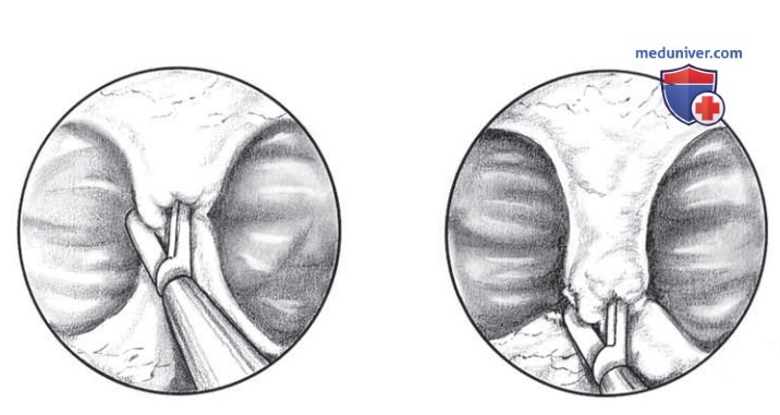 Гистероскопическое рассечение внутриматочной перегородки: техника операции, этапы