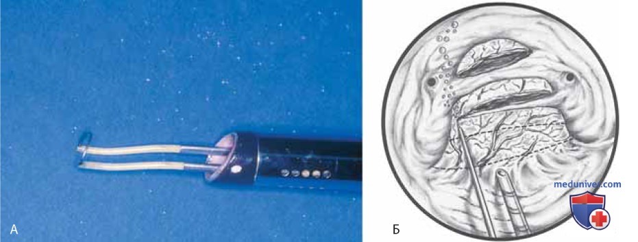 Гистероскопическая резекция подслизистой миомы: техника операции, этапы