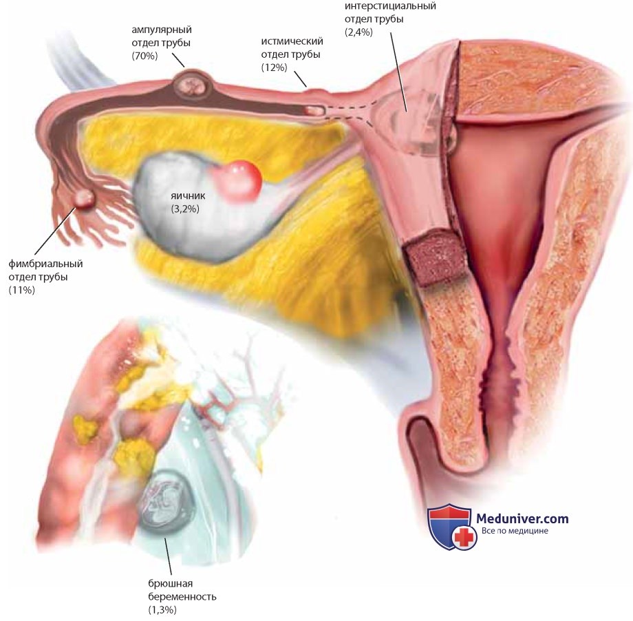 Операция линейная сальпингостомия по поводу трубной беременности