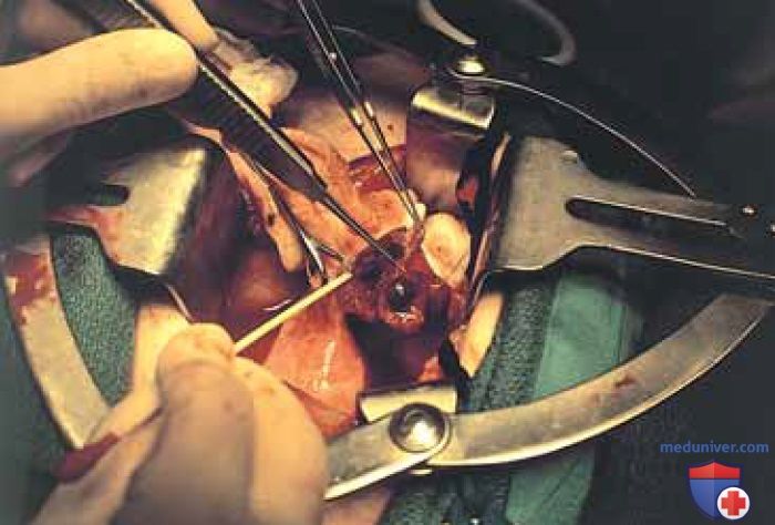 Операция линейная сальпингостомия по поводу трубной беременности