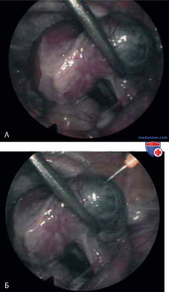 Операция иссечения трубного угла и тубэктомия по поводу беременности в трубном углу