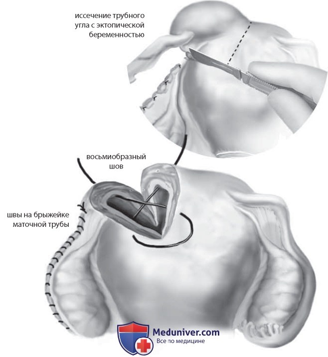 Операция иссечения трубного угла и тубэктомия по поводу беременности в трубном углу