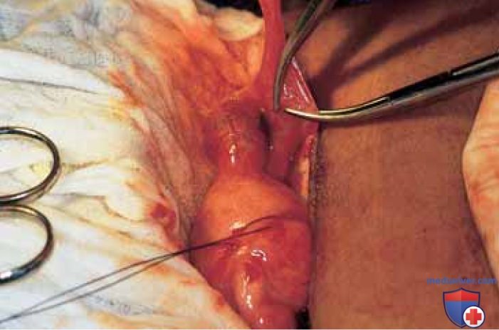 Операция тубэктомия по поводу беременности в истмическом отделе трубы
