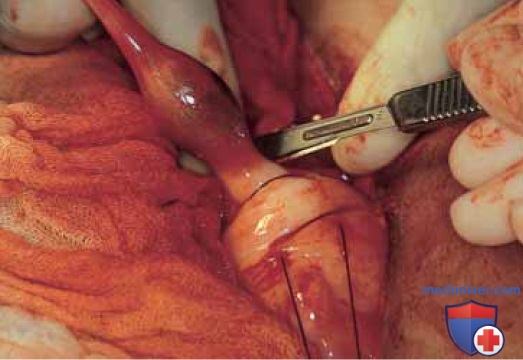 Операция тубэктомия по поводу беременности в истмическом отделе трубы