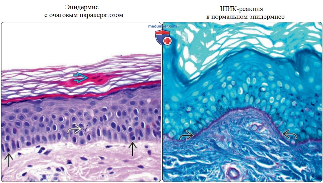 Эпидермис с кератиноцитами и меланоцитами - нормальная гистология под микроскопом