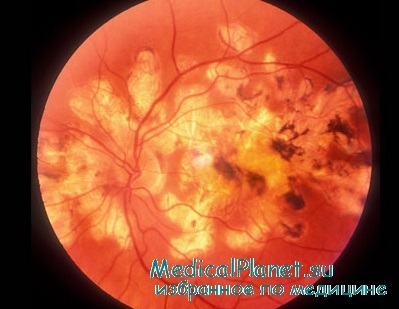 диабетическая ретинопатия