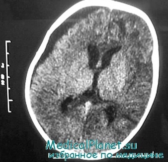 Субдуральная гематома головного мозга у детей thumbnail
