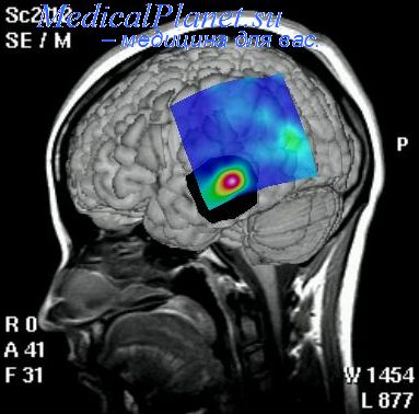 электроэнцефалография при эпилепсии