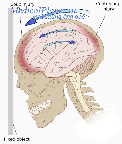 ранения головного мозга