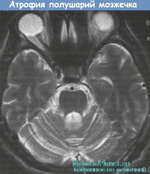 Атрофия полушарий мозжечка на МРТ
