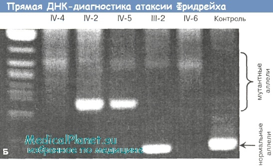 ДНК-диагностика атаксии Фридрейха