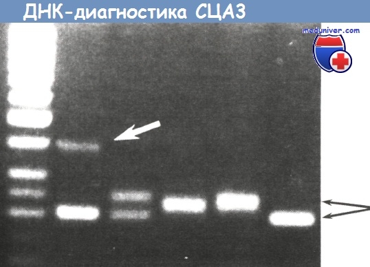 ДНК-диагностика спиноцеребеллярной атаксии 3-го типа