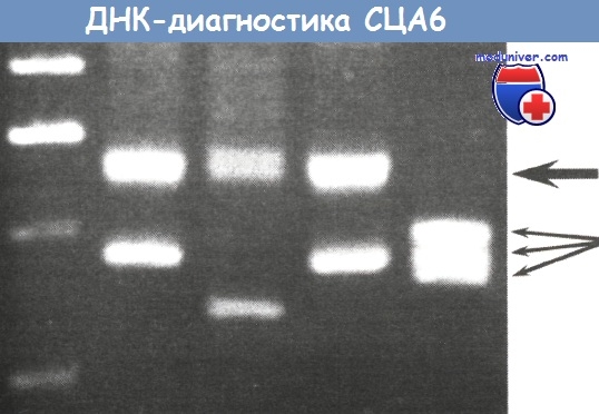 ДНК-диагностика спиноцеребеллярной атаксии 6-го типа