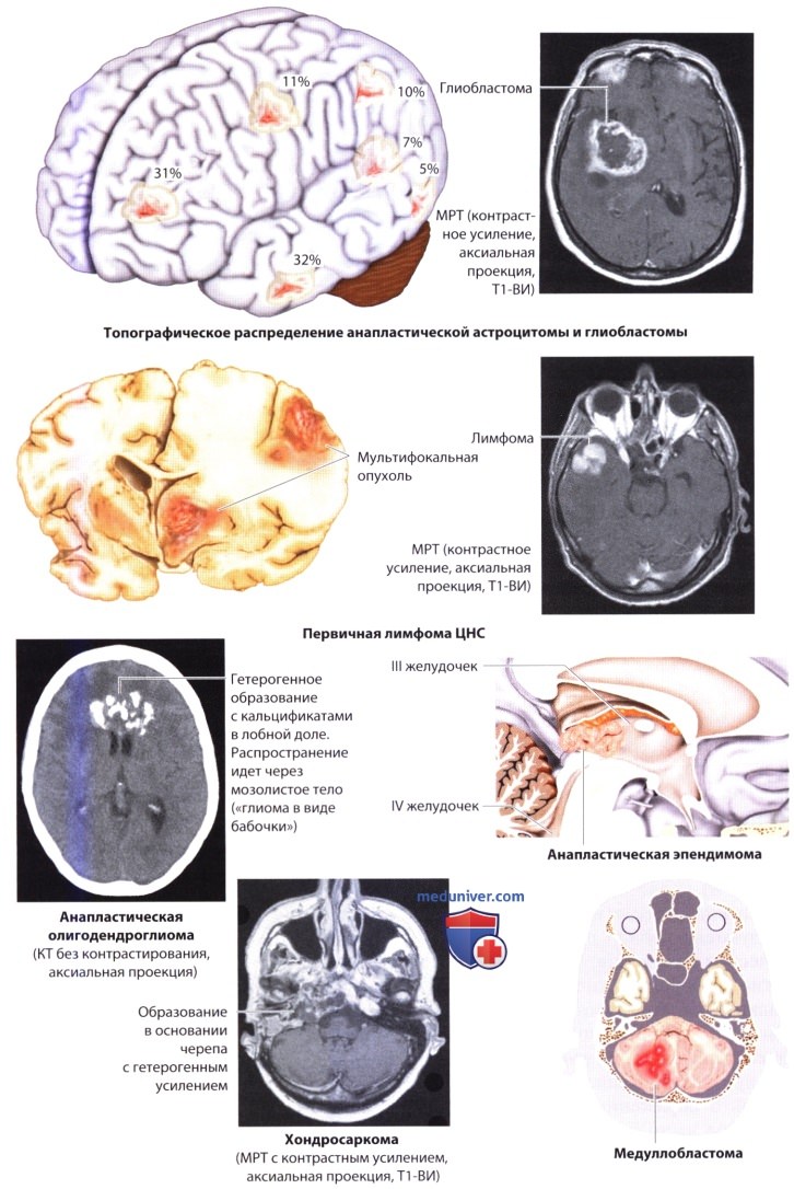Опухоли мозга III и IV степени злокачественности по классификации ВОЗ