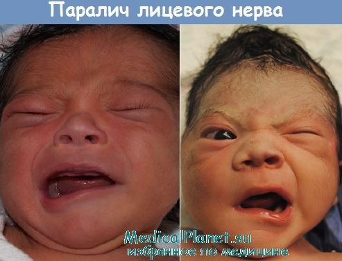 паралич лицевого нерва у новорожденных детей