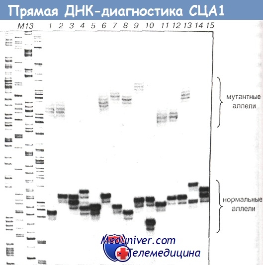Прямая ДНК-диагностика спиноцеребеллярной атаксии 1-го типа