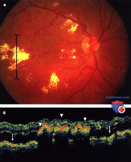 Диабетическая ретинопатия: причины, диагностика, лечение