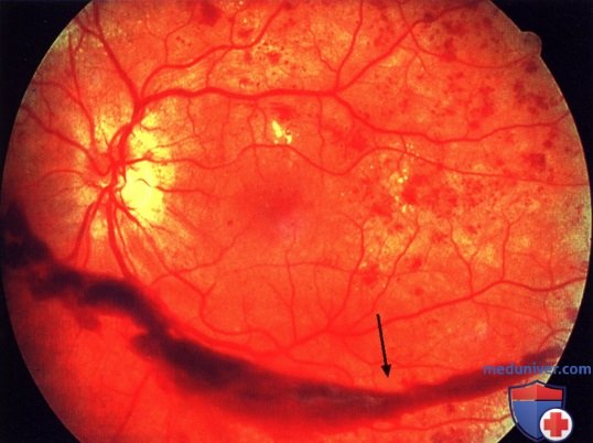 Диабетическая ретинопатия: причины, диагностика, лечение