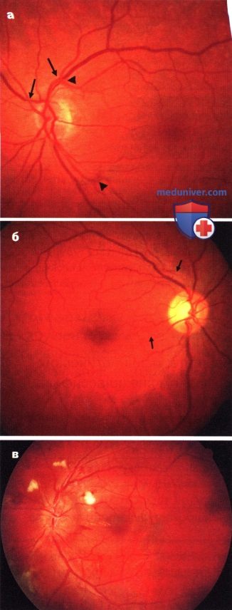 Гипертоническая ретинопатия и склеротические изменения глазного дна