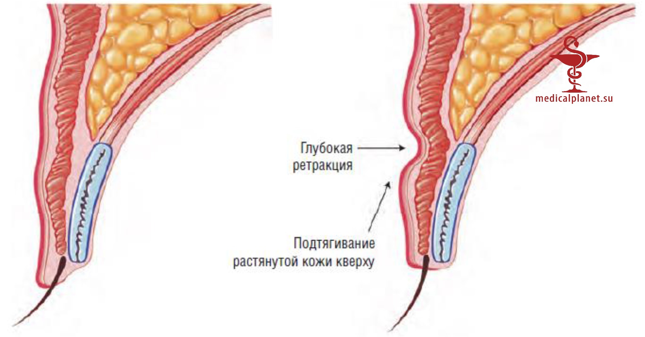 Глубина пальпебральной борозды при азиатской (ориентальной) блефаропластике