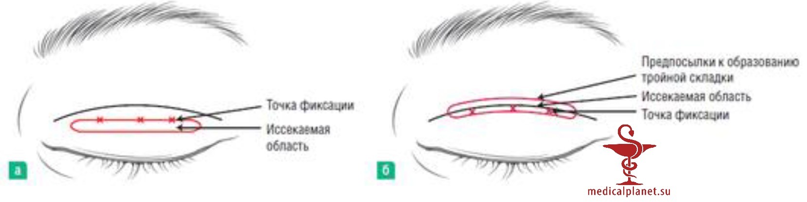 Иссечение мягких тканей при азиатской (ориентальной) блефаропластике
