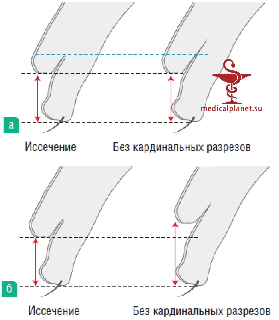 Следует ли иссекать кожу у молодых пациентов при азиатской (ориентальной) блефаропластике?