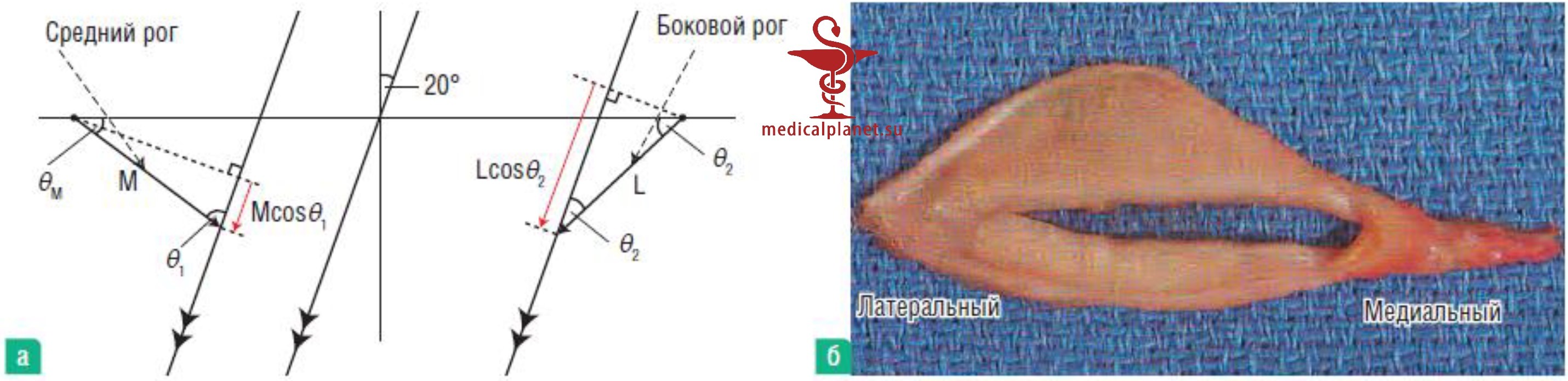 Методы фиксации при азиатской (ориентальной) блефаропластике